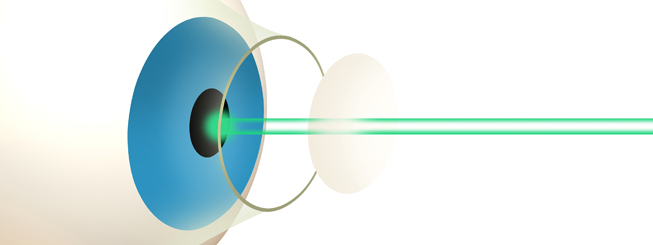 Laser eye surgery in Nottingham